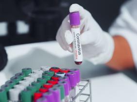 OMS : les effets de la pandémie de la Covid-19 seront ressentis pendant des décennies Covid-19-positif-3_2